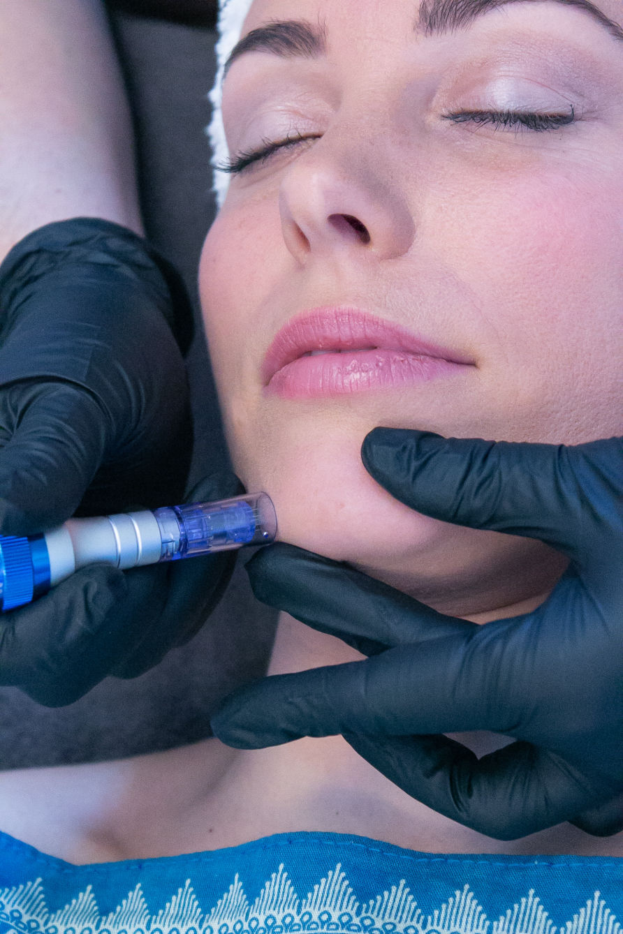 Microneedling Skin Rejuvenation